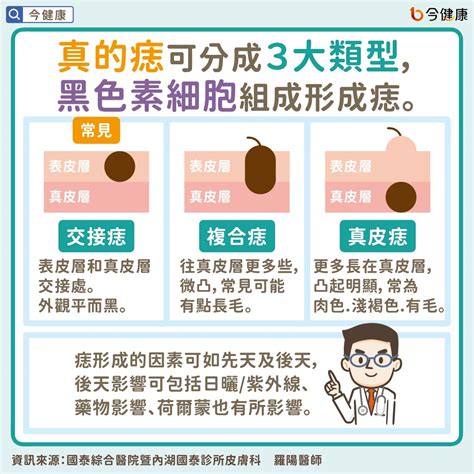 凸起來的痣|皮膚長痣是皮膚癌嗎？常見症狀，簡單3招自我檢測｜ 